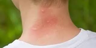 Mosquito bites on boy's neck
