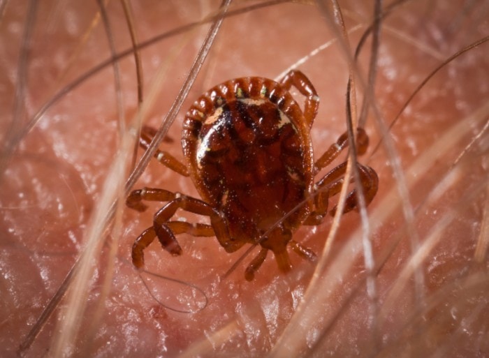 Tick embedded in a person's skin